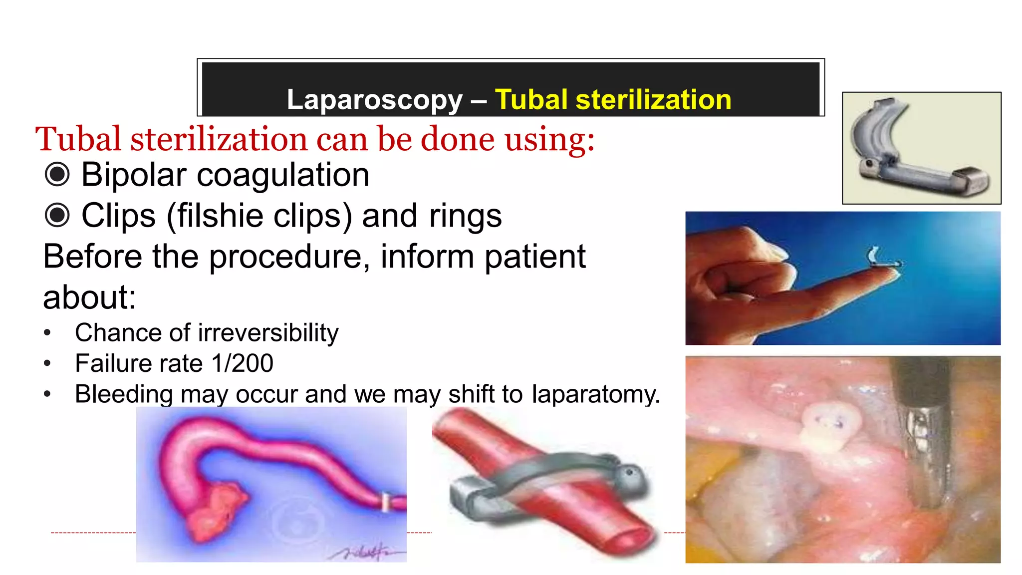 Laparoscopy – Tubal sterilization
Tubal sterilization can be done using:
◉ Bipolar coagulation
◉ Clips (filshie clips) and rings
Before the procedure, inform patient
about:
• Chance of irreversibility
• Failure rate 1/200
• Bleeding may occur and we may shift to laparatomy.
 