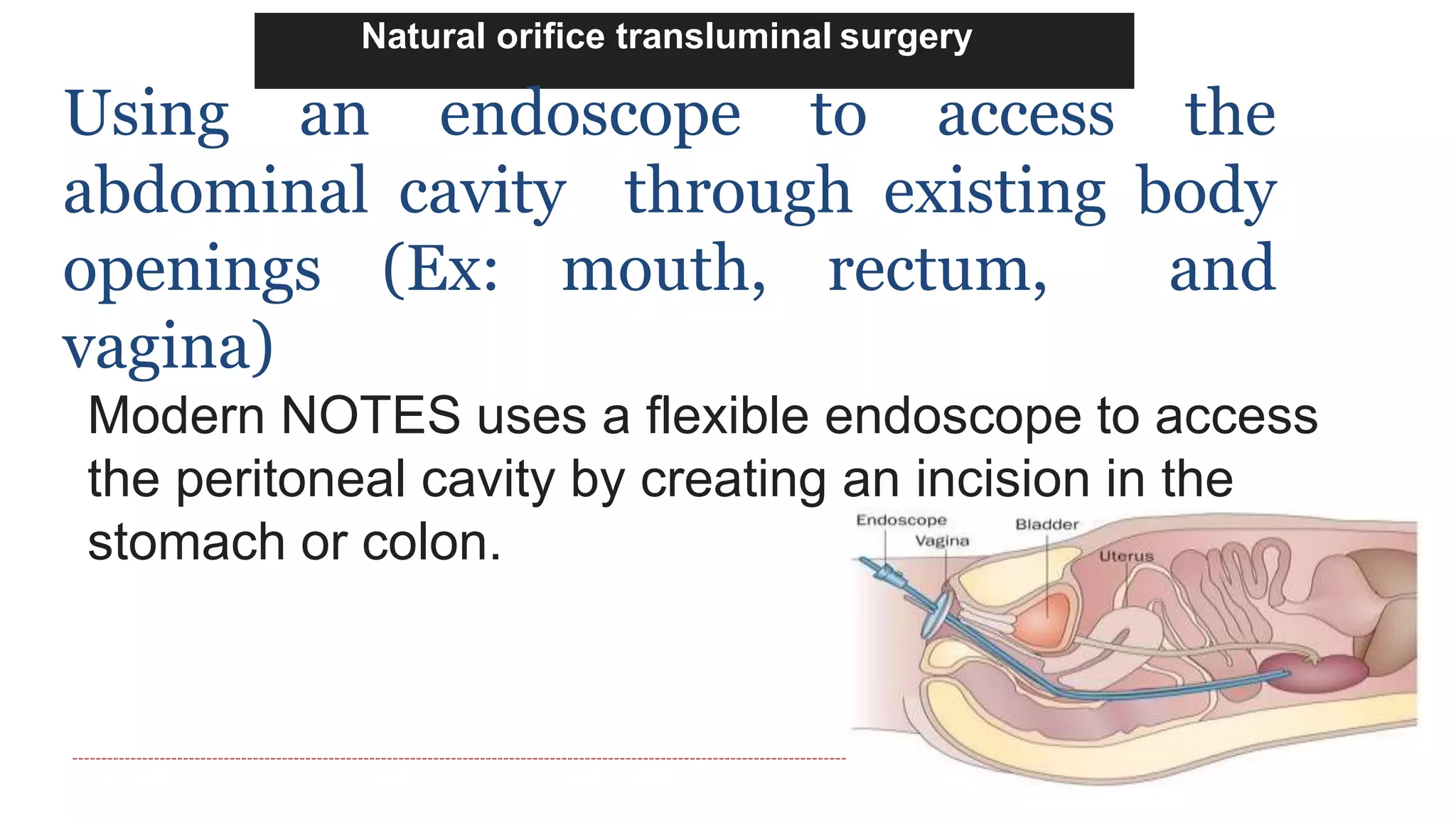 Natural orifice transluminal surgery
Using an endoscope to access the
abdominal cavity through existing body
openings (Ex: mouth, rectum, and
vagina)
Modern NOTES uses a flexible endoscope to access
the peritoneal cavity by creating an incision in the
stomach or colon.
 