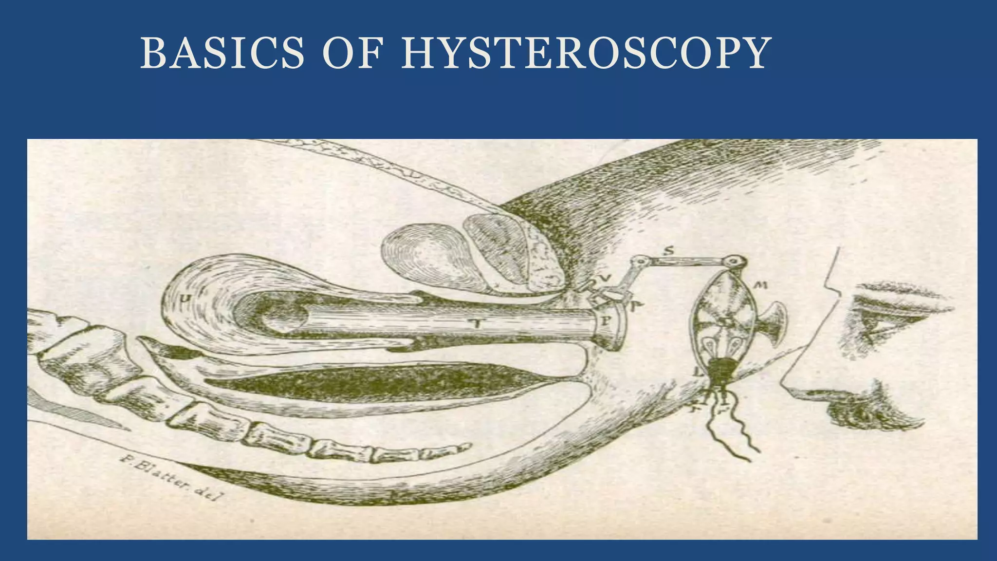 BASICS OF HYSTEROSCOPY
 
