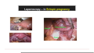 Laparoscopy – in Ectopic pregnancy
 