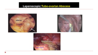 Laparoscopic:Tubo-ovarian Abscess
 