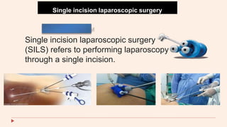Single incision laparoscopic surgery
Single incision laparoscopic surgery
(SILS) refers to performing laparoscopy
through a single incision.
 