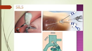 Laparoscopy