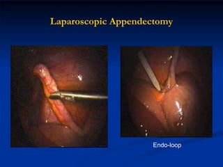 Laparoscopic Appendectomy Endo-loop 