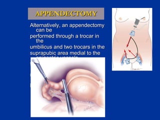 APPENDECTOMY Alternatively, an appendectomy can be  performed through a trocar in the  umbilicus and two trocars in the  suprapubic area medial to the epigastric vessels for a superb cosmetic result (if an extended  right hemicolectomy is to be performed, the  hepatic flexure positioning is preferred.) 