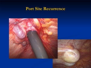 Port Site Recurrence 
