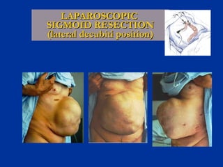 LAPAROSCOPIC  SIGMOID RESECTION (lateral decubiti position) 