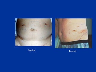 Lateral Supine 