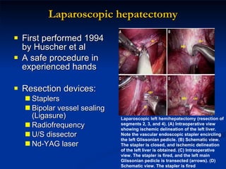 Laparoscopic hepatectomy First performed 1994 by Huscher et al A safe procedure in experienced hands Resection devices: Staplers Bipolar vessel sealing (Ligasure) Radiofrequency  U/S dissector Nd-YAG laser Laparoscopic left hemihepatectomy (resection of segments 2, 3, and 4). (A) Intraoperative view showing ischemic delineation of the left liver. Note the vascular endoscopic stapler encircling the left Glissonian pedicle. (B) Schematic view. The stapler is closed, and ischemic delineation of the left liver is obtained. (C) Intraoperative view. The stapler is fired, and the left main Glissonian pedicle is transected (arrows). (D) Schematic view. The stapler is fired  