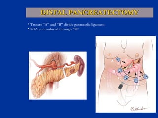 DISTAL PANCREATECTOMY D E C B A Trocars “A” and “B” divide gastrocolic ligament GIA is introduced through “D” 
