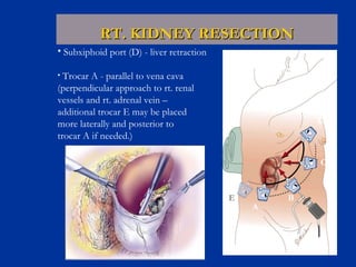 RT. KIDNEY RESECTION Subxiphoid port (D) - liver retraction Trocar A - parallel to vena cava  (perpendicular approach to rt. renal  vessels and rt. adrenal vein – additional trocar E may be placed  more laterally and posterior to  trocar A if needed.) B C D A E 