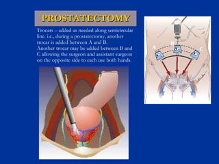 PROSTATECTOMY A B C Trocars – added as needed along semicircular  line. i.e., during a prostatectomy, another  trocar is added between A and B. Another trocar may be added between B and  C allowing the surgeon and assistant surgeon on the opposite side to each use both hands. 