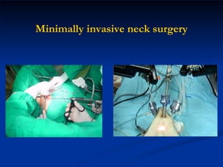 Minimally invasive neck surgery 