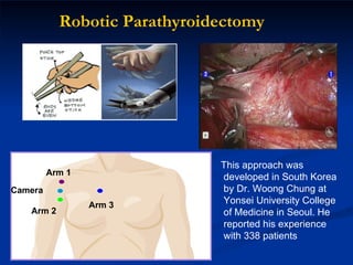 Robotic Parathyroidectomy Arm 1 Camera Arm 2 Arm 3 This approach was  developed in South Korea by Dr. Woong Chung at Yonsei University College of Medicine in Seoul. He reported his experience with 338 patients 