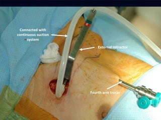 Fourth arm trocar External retractor Connected with continuous suction system 