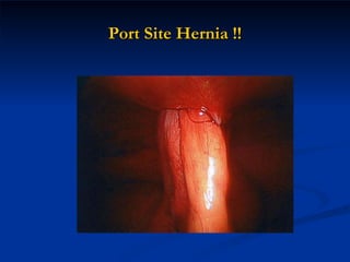 Port Site Hernia !! 