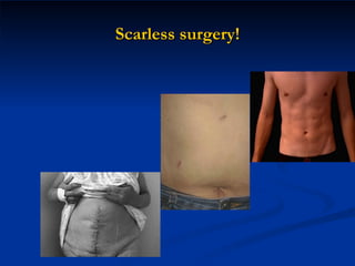 Scarless surgery! 