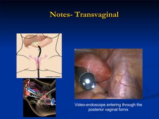 Notes- Transvaginal Video-endoscope entering through the posterior vaginal fornix 