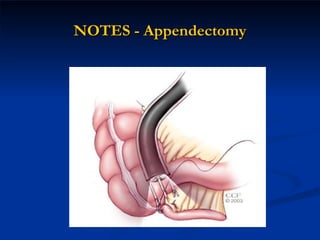 NOTES - Appendectomy 