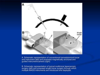 A. Schematic representation of conventional transabdominal trocar and instrument (left) and proposed magnetically anchored and guided instrument/camera (right).  B. Schematic representation of typical multitrocar laparoscopic surgery (left) and proposed single trocar surgery through which multiple MAGS instruments are introduced and deployed.  