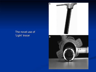 The novel use of ‘Light’ trocar 