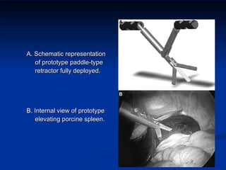 A. Schematic representation of prototype paddle-type retractor fully deployed.  B. Internal view of prototype elevating porcine spleen.  