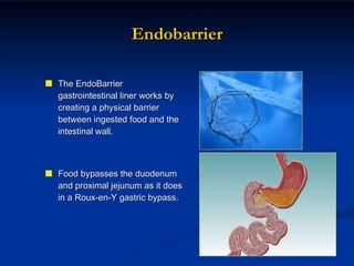 Endobarrier The EndoBarrier gastrointestinal liner works by creating a physical barrier between ingested food and the intestinal wall.  Food bypasses the duodenum and proximal jejunum as it does in a Roux-en-Y gastric bypass.  