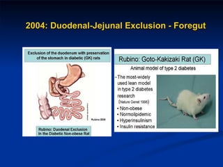 2004: Duodenal-Jejunal Exclusion - Foregut 
