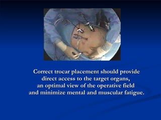 Correct trocar placement should provide direct access to the target organs,  an optimal view of the operative field  and minimize mental and muscular fatigue. 