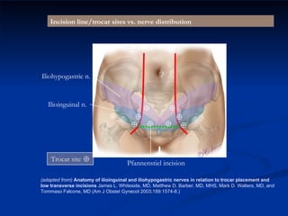 (adapted from)  Anatomy of ilioinguinal and iliohypogastric nerves in relation to trocar placement and low transverse incisions  James L. Whiteside, MD, Matthew D. Barber, MD, MHS, Mark D. Walters, MD, and Tommaso Falcone, MD (Am J Obstet Gynecol 2003;189:1574-8.) Iliohypogastric n. Ilioinguinal n. Incision line/trocar sites vs. nerve distribution Epigastric a. Trocar site Pfannenstiel incision 