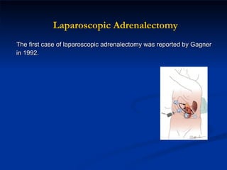 The first case of laparoscopic adrenalectomy was reported by Gagner in 1992. Laparoscopic Adrenalectomy 