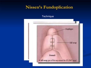 Nissen’s Fundoplication Technique 