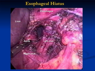 Esophageal Hiatus Liver Esophagus Left crus Right crus Aorta 