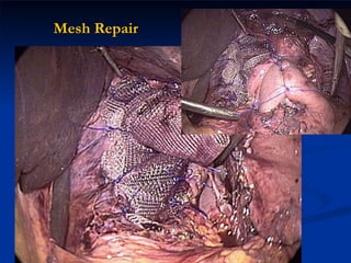 Mesh Repair 