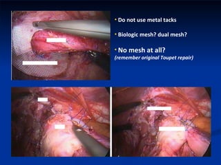 Polypropylene mesh Esophagus Do not use metal tacks Biologic mesh? dual mesh? No mesh at all?  (remember original Toupet repair) Mesh Wrap Circular mesh Fundoplication 