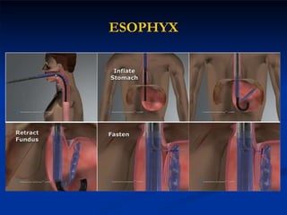 ESOPHYX 