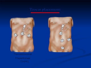 Trocar placement: Transabdominal Preperitoneal (TAPP) Totally Extraperitoneal (TEP) Additional trocar 