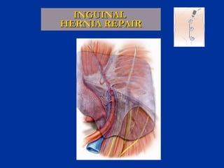 INGUINAL  HERNIA REPAIR 