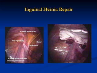 Inguinal Hernia Repair 