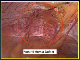 Ventral Hernia Defect 