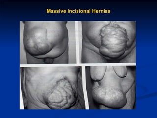 Massive Incisional Hernias 