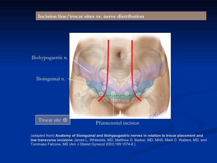 Iliohypogastric Nerve Appendectomy Diet