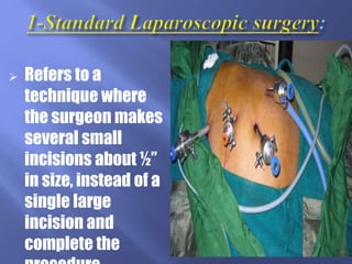  Refers to a
technique where
the surgeon makes
several small
incisions about ½”
in size, instead of a
single large
incision and
complete the
 