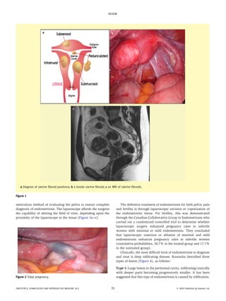 meticulous method of evaluating the pelvis to ensure complete
diagnosis of endometriosis. The laparoscope affords the surgeon
the capability of altering the field of view, depending upon the
proximity of the laparoscope to the tissue (Figure 3aec).
The definitive treatment of endometriosis for both pelvic pain
and fertility is through laparoscopic excision or vaporization of
the endometriotic tissue. For fertility, this was demonstrated
through the Canadian Collaborative Group in Endometriosis who
carried out a randomized controlled trial to determine whether
laparoscopic surgery enhanced pregnancy rates in infertile
women with minimal or mild endometriosis. They concluded
that laparoscopic resection or ablation of minimal and mild
endometriosis enhances pregnancy rates in infertile women
(cumulative probabilities, 30.7% in the treated group and 17.7%
in the untreated group).
Clinically, the most difficult form of endometriosis to diagnose
and treat is deep infiltrating disease. Koninckx described three
types of lesion (Figure 4), as follows:
Type 1: Large lesion in the peritoneal cavity, infiltrating conically
with deeper parts becoming progressively smaller. It has been
suggested that this type of endometriosis is caused by infiltration.
a Diagram of uterine fibroid positions; b a fundal uterine fibroid; c an MRI of uterine fibroids.
Figure 1
Figure 2 Tubal pregnancy.
REVIEW
OBSTETRICS, GYNAECOLOGY AND REPRODUCTIVE MEDICINE 20:2 35 Ó 2009 Published by Elsevier Ltd.