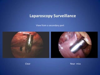 Gynecological Surgeries