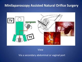  MINILAPAROSCOPY ASSISTED NATURAL ORIFICE SURGERY    (MANOS)Gynecological Surgeries