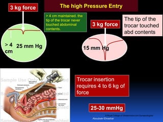 © Royal College of Obstetricians and Gynaecologists
3 kg force
3 kg force
25 mm Hg 15 mm Hg
The tip of the
trocar touched
abd contents
> 4 cm maintained. the
tip of the trocar never
touched abdominal
contents.
Trocar insertion
requires 4 to 6 kg of
force
> 4
cm
The high Pressure Entry
25-30 mmHg
Aboubakr Elnashar
 