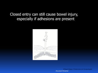© Royal College of Obstetricians and Gynaecologists
Closed entry can still cause bowel injury,
especially if adhesions are present
Aboubakr Elnashar
 