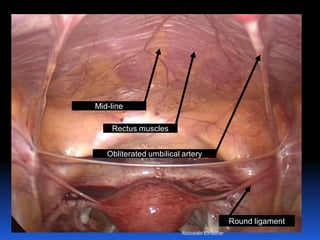© Royal College of Obstetricians and Gynaecologists
Round ligament
Obliterated umbilical artery
Rectus muscles
Mid-line
Aboubakr Elnashar
 