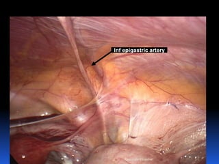 © Royal College of Obstetricians and Gynaecologists
Inf epigastric artery
Aboubakr Elnashar
 